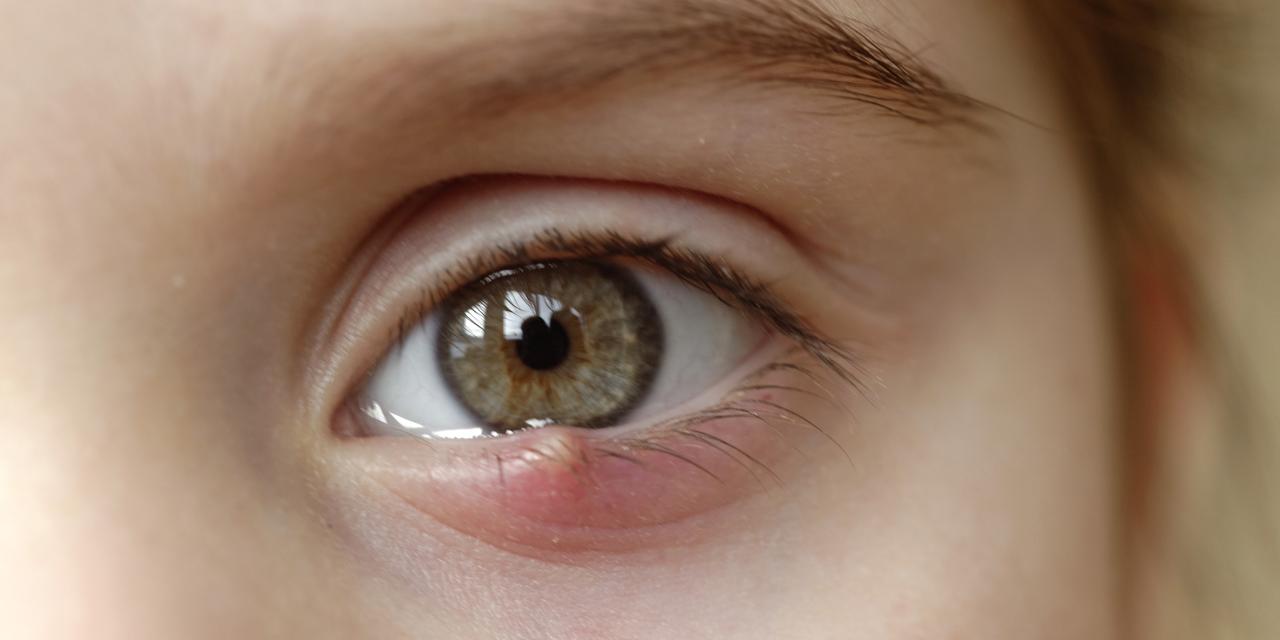 Close-up of a child's eye stye. 
