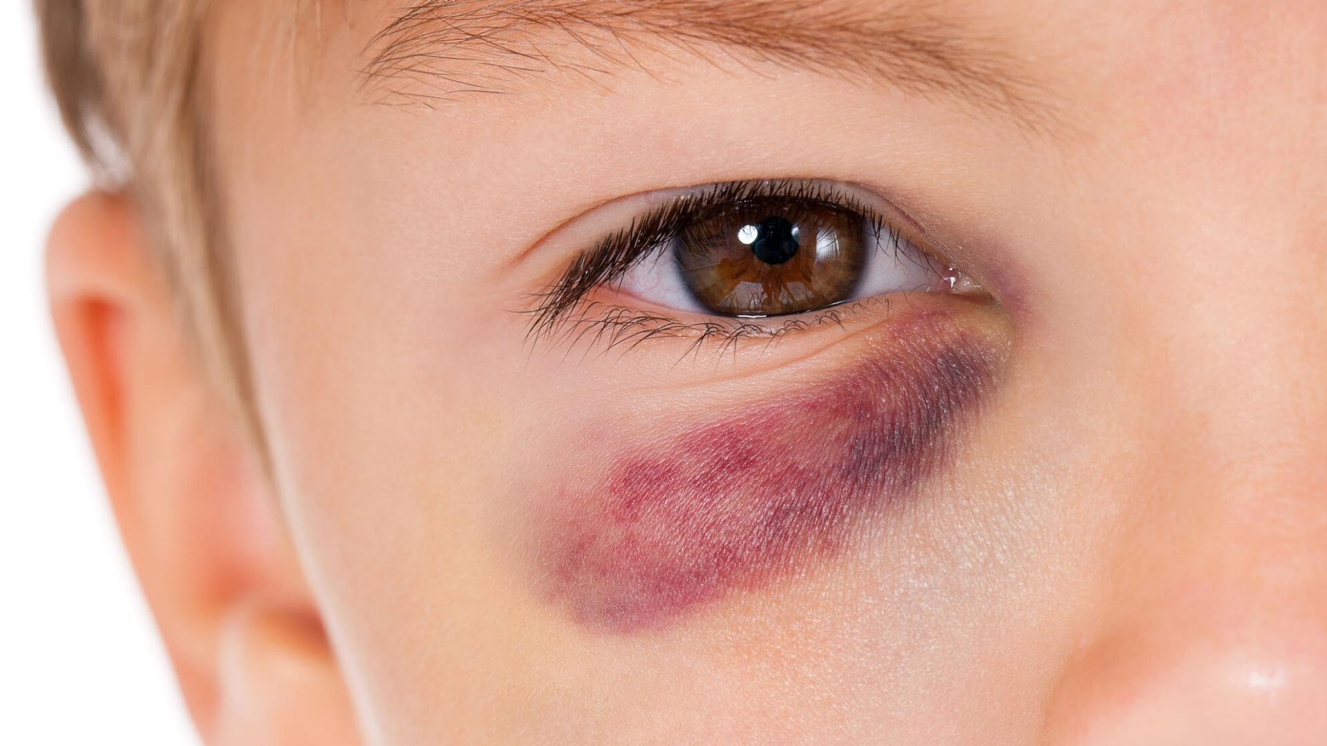 What is a black eye, how long does it last, and what causes it?