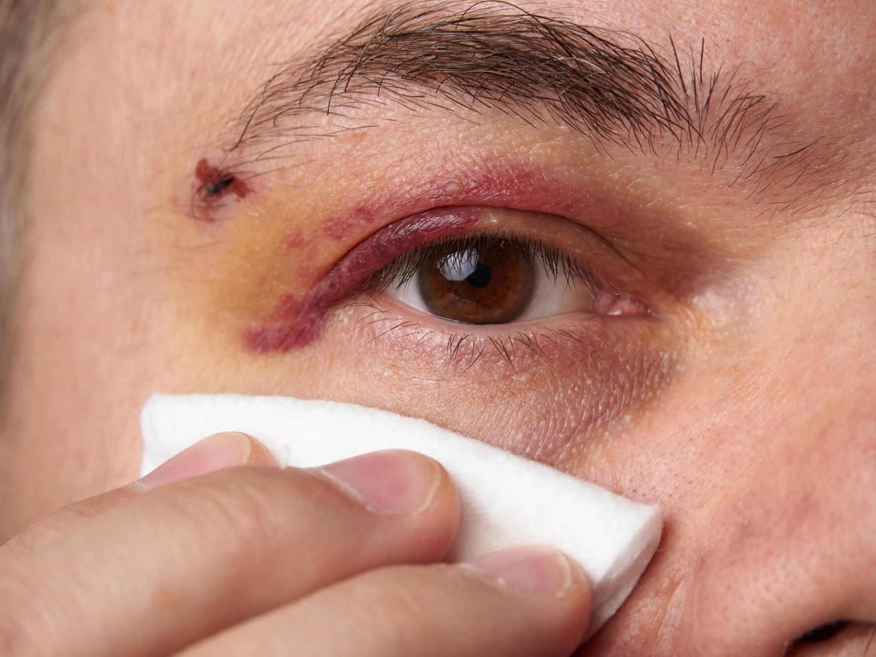Applying a cold compress to the eye area shortly after an injury can reduce swelling and soothe pain.