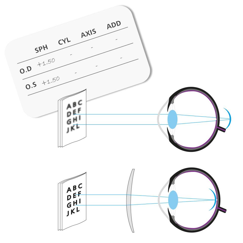 A plus prescription and a convex lens to bend light