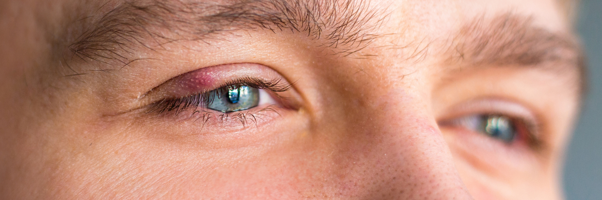 Eyelid infection (blepharitis)