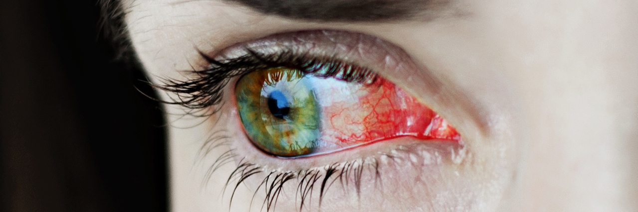 Closeup of irritated or infected red bloodshot eyes - uveitis